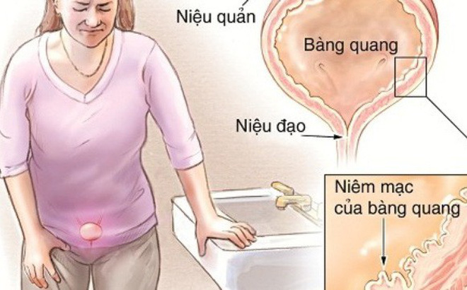 Viêm bàng quang